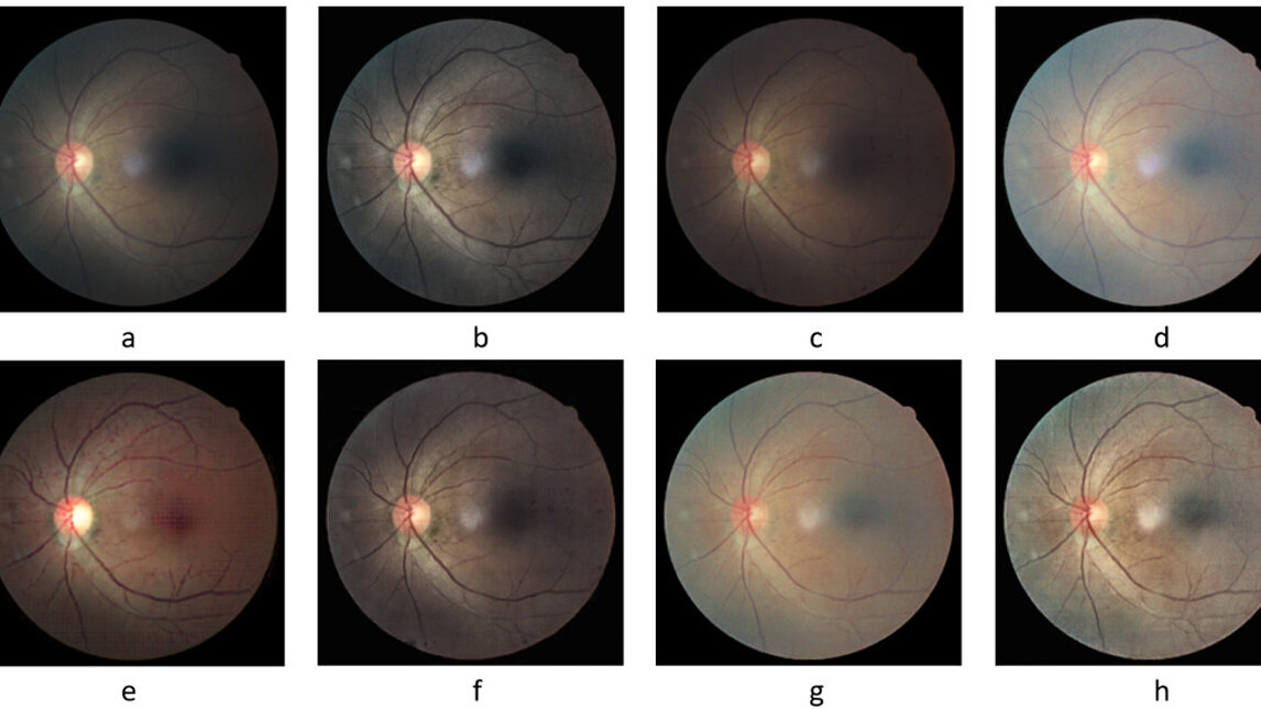 Los oftalmólogos del país podrían hacer diagnósticos de enfermedades oculares con base en las imágenes de fondo de ojo tomadas con un celular. Cortesía - Andrés Pérez