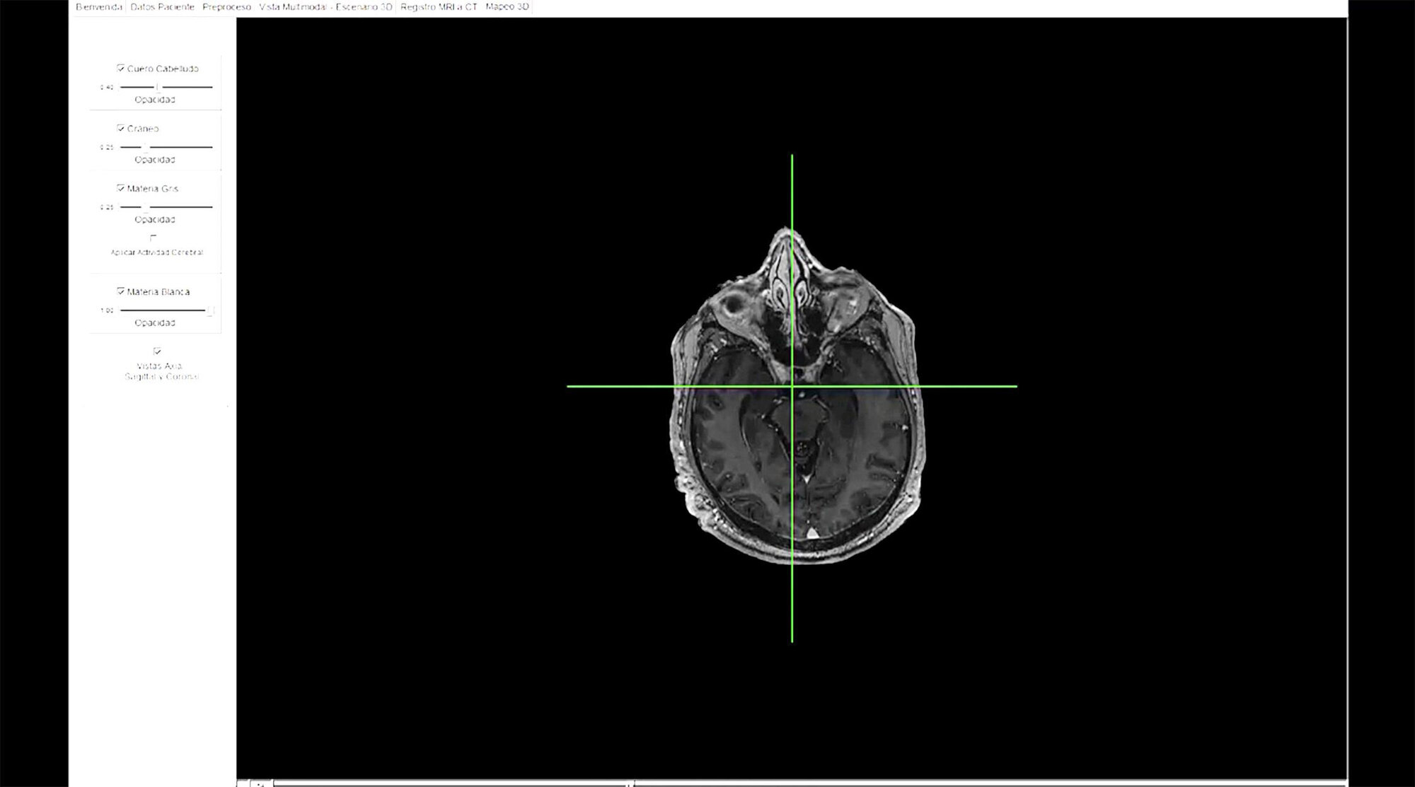 Mapeo de la actividad cerebral permitirá conocer gráficamente las áreas de intervención en cirugías de párkinson.