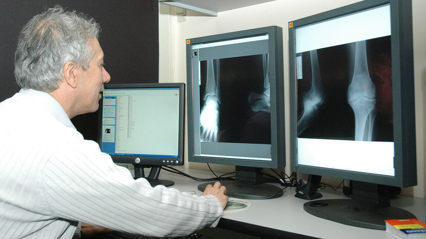 Los huesos son susceptibles a daños significativos causados por tumores femorales, cáncer u osteoporosis, que pueden producir fracturas de gran tamaño. Foto: Unimedios