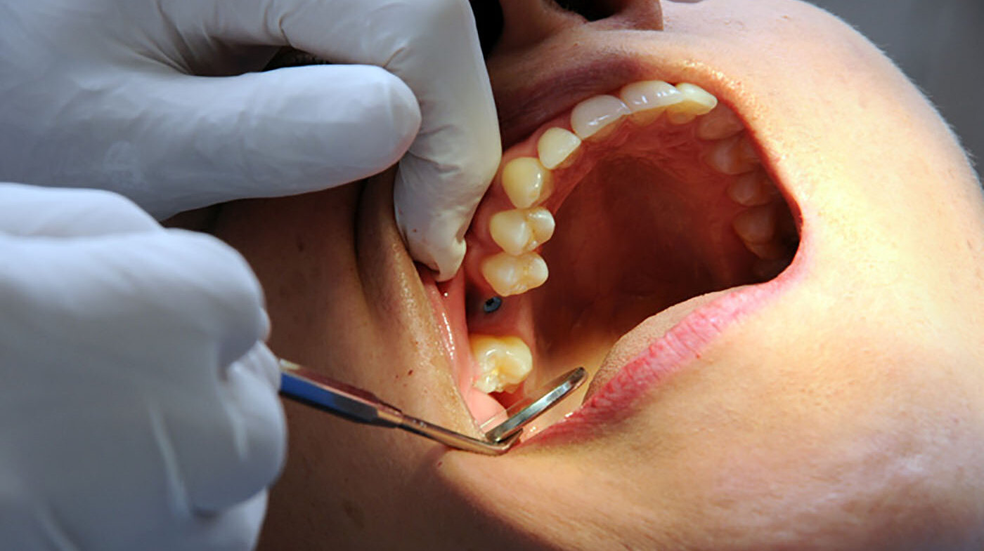 El rechazo de implantes por el organismo puede implicar daños en tejido sano. Foto: archivo Unimedios.