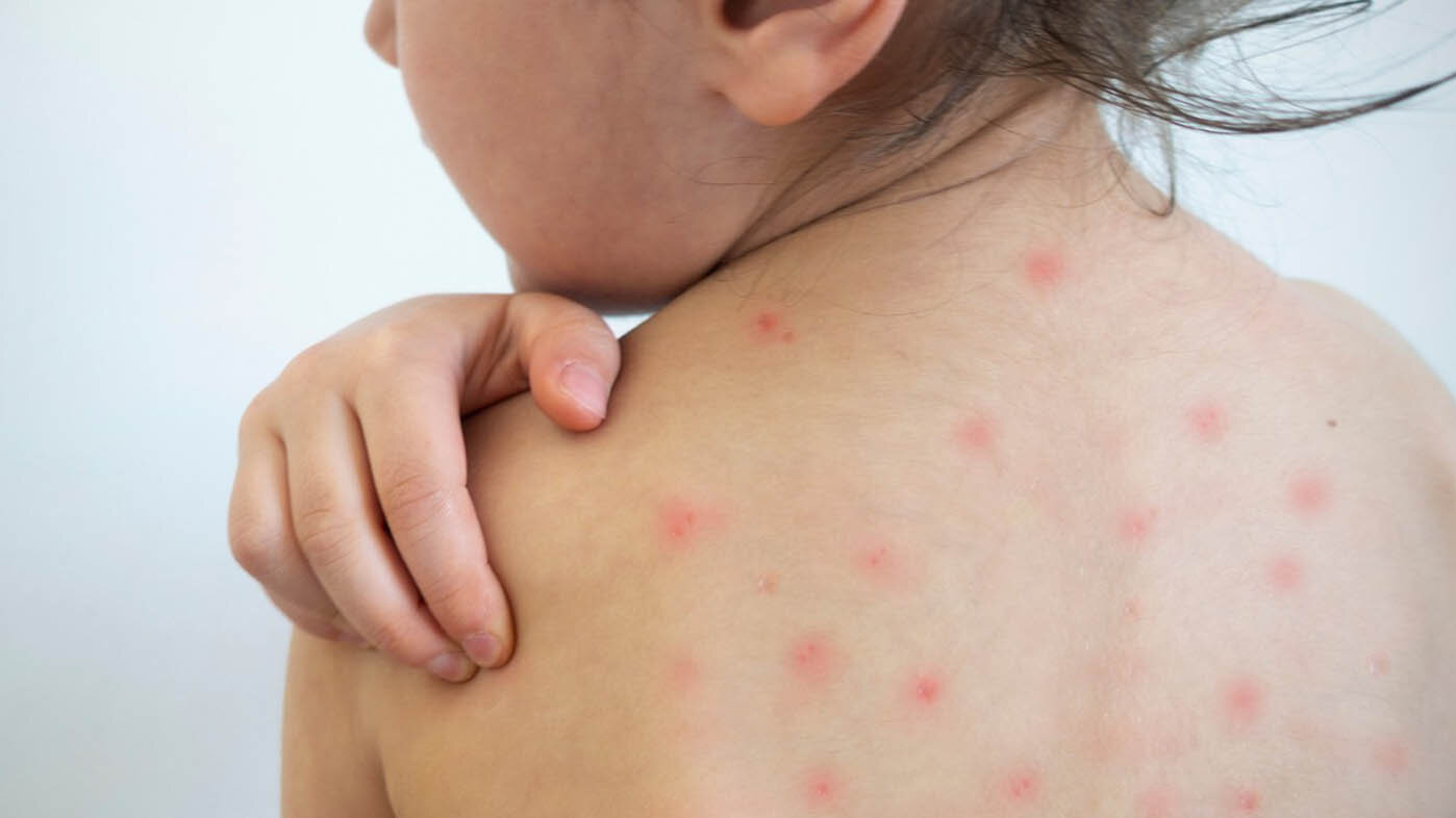 El riesgo de adquirir varicela en la vida es superior al 95,1 %, especialmente durante la niñez. Foto: Alcaldía Municipal de Dosquebradas.