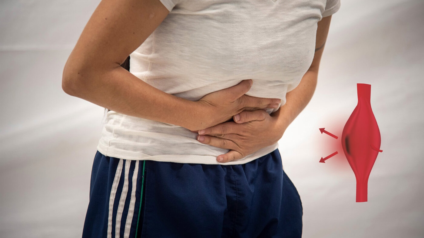 La ruptura de un aneurisma aórtico abdominal ocurre cuando la pared de la aorta se rompe y la sangre se derrama hacia el abdomen. Fotos: Archivos Unimedios