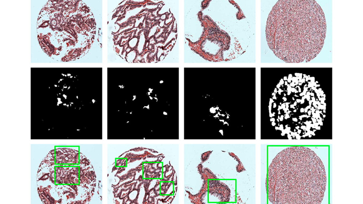 Segmentación de las imágenes histológicas mediante el proceso de pixelación para identificar zonas con cáncer. Foto: Julián David Vargas López, magíster en Automatización Industrial de la UNAL Sede Manizales.