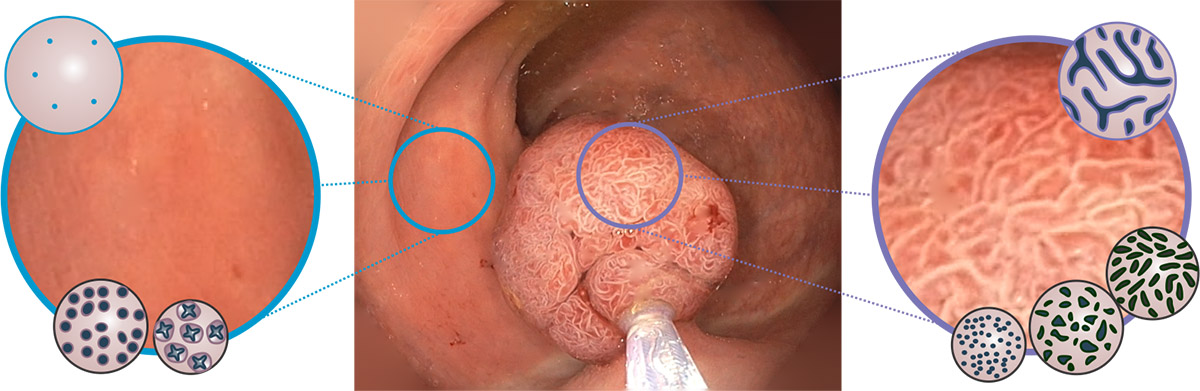 Desde un punto de vista técnico, la evolución de esta enfermedad se conoce como historia natural del cáncer colorectal (CCR).