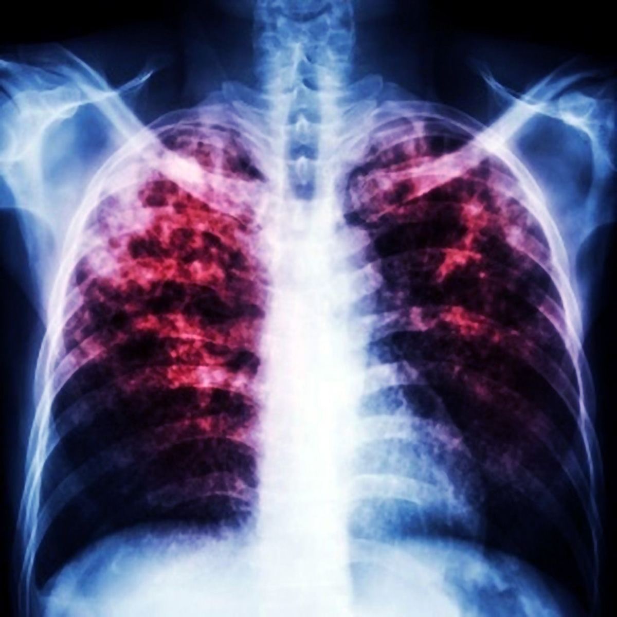 La tuberculosis es una enfermedad bacteriana que suele atacar los pulmones. Foto: Creative Commons